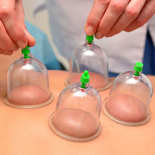 HIJAMA (CUPPING THERAPY) BY AZAM PHYSIOTHERAPY